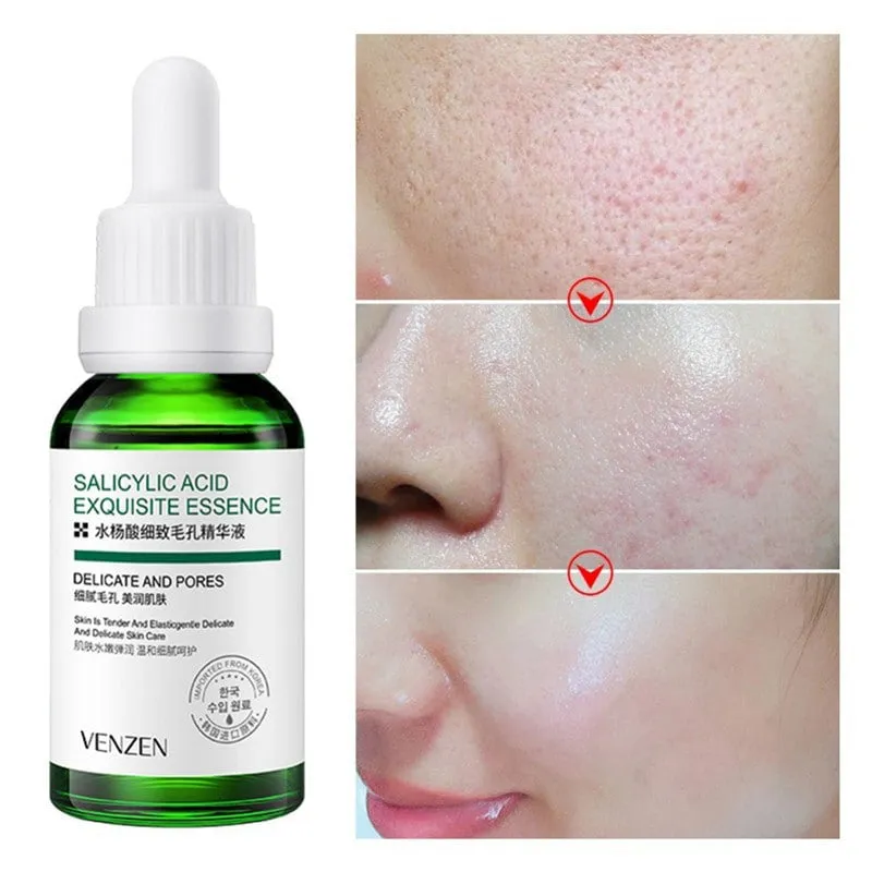 KIT/COMBO X 3 CIDO SALICíLICO ANTIACNé | TRATAMIENTO FACIAL PARA EL ACNé  BIOAQUA