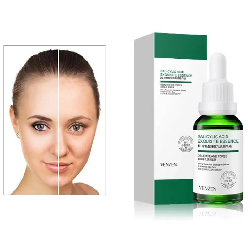 KIT/COMBO X 3 CIDO SALICíLICO ANTIACNé | TRATAMIENTO FACIAL PARA EL ACNé  BIOAQUA